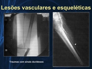 Lesões vasculares e esqueléticas




  Traumas com sinais duvidosos
 