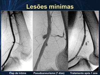 Lesões mínimas




Flap de íntima     Pseudoaneurisma (7 dias)   Tratamento após 1 ano
 