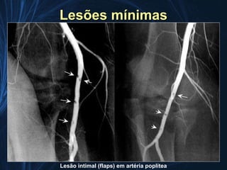 Lesões mínimas




Lesão intimal (flaps) em artéria poplítea
 