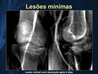 Lesões mínimas




Lesão intimal com resolução após 4 dias
 