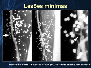 Lesões mínimas




Hematoma mural   Estenose da AFS (1a). Realizado enxerto com sucesso
 