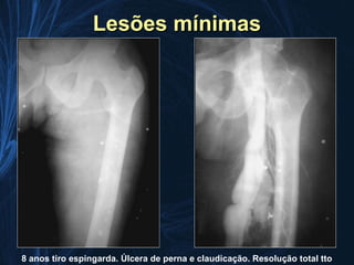 Lesões mínimas




8 anos tiro espingarda. Úlcera de perna e claudicação. Resolução total tto
 