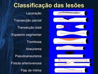 Classificação das lesões
          Laceração

 Transecção parcial

    Transecção total

Espasmo segmentar

          Trombose

          Aneurisma

  Pseudoaneurisma

Fístula arteriovenosa

      Flap de íntima
 