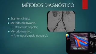 MÉTODOS DIAGNÓSTICO
 Examen clínico;
 Método no invasivo:
• Ultrasonido doppler;
 Método invasivo:
• Arteriografía (gold standard);
 