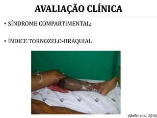 AVALIAÇÃO CLÍNICA
• SÍNDROME COMPARTIMENTAL;
• ÍNDICE TORNOZELO-BRAQUIAL
(Maffei et al, 2015)
 