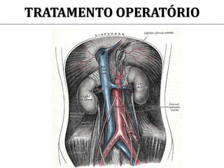 TRATAMENTO OPERATÓRIO
 