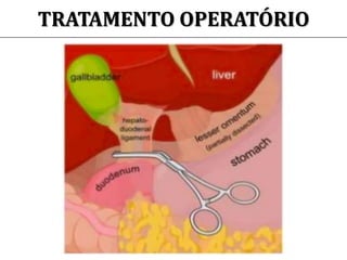 TRATAMENTO OPERATÓRIO
 