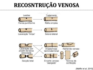 RECOSNTRUÇÃO VENOSA
(Maffei et al, 2015)
 