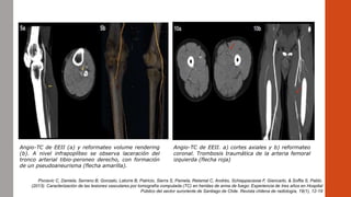 Angio-TC de EEII (a) y reformateo volume rendering
(b). A nivel infrapoplíteo se observa laceración del
tronco arterial tibio-peroneo derecho, con formación
de un pseudoaneurisma (flecha amarilla).
Angio-TC de EEII. a) cortes axiales y b) reformateo
coronal. Trombosis traumática de la arteria femoral
izquierda (flecha roja)
Pivcevic C, Daniela, Serrano B, Gonzalo, Latorre B, Patricio, Sierra S, Pamela, Retamal C, Andrés, Schiappacasse F, Giancarlo, & Soffia S, Pablo.
(2013). Caracterización de las lesiones vasculares por tomografía computada (TC) en heridas de arma de fuego: Experiencia de tres años en Hospital
Público del sector suroriente de Santiago de Chile. Revista chilena de radiología, 19(1), 12-19
 