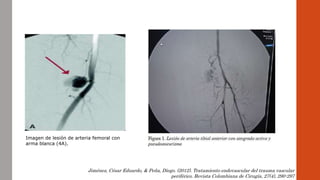 Imagen de lesión de arteria femoral con
arma blanca (4A).
Jiménez, César Eduardo, & Peña, Diego. (2012). Tratamiento endovascular del trauma vascular
periférico. Revista Colombiana de Cirugía, 27(4), 290-297
 