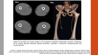Angio-TC de EEII (a) cortes axiales y (b) volumen rendering reformateo coronal. Trombosis
de la arteria femoral derecha (flecha amarilla), asociado a síndrome compartimental del
muslo derecho
Pivcevic C, Daniela, Serrano B, Gonzalo, Latorre B, Patricio, Sierra S, Pamela, Retamal C, Andrés, Schiappacasse F, Giancarlo, & Soffia S, Pablo.
(2013). Caracterización de las lesiones vasculares por tomografía computada (TC) en heridas de arma de fuego: Experiencia de tres años en Hospital
Público del sector suroriente de Santiago de Chile. Revista chilena de radiología, 19(1), 12-19
 