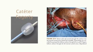 Catéter
Fogarty
 