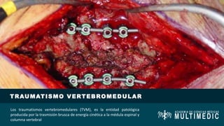 TRAUMATISMO VERTEBROMEDULAR
Los traumatismos vertebromedulares (TVM), es la entidad patológica
producida por la trasmisión brusca de energía cinética a la médula espinal y
columna vertebral
 