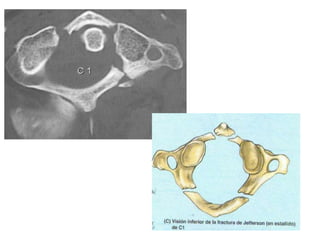 Vertebrogram TRAUMA VERTEBRO MEDULAR.pptx