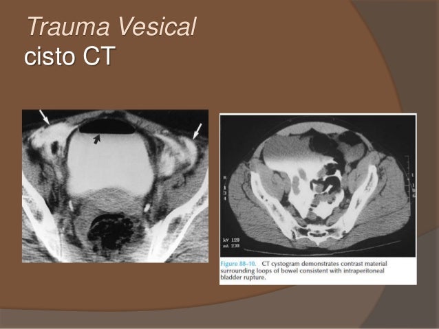 Trauma Vesical