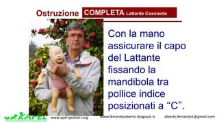 www.apel-pediatri.org www.ferrandoalberto.blogspot.it.									alberto.ferrando1@gmail.com
Ostruzione COMPLETA Lattante Cosciente
Con la mano
assicurare il capo
del Lattante
fissando la
mandibola tra
pollice indice
posizionati a “C”.
 