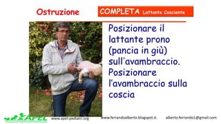 www.apel-pediatri.org www.ferrandoalberto.blogspot.it.									alberto.ferrando1@gmail.com
Ostruzione COMPLETA Lattante Cosciente
Posizionare il
lattante prono
(pancia in giù)
sullʼavambraccio.
Posizionare
l’avambraccio sulla
coscia
 