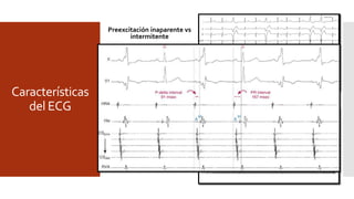 Características
del ECG
Preexcitación inaparente vs
intermitente
Inaparente: CA del BT sin
preexcitación.
↑conducción NAV
Prolongación conducción
interatrial (BT lateral izquierdo)
Prolongación conducción BT
Intermitente: Qrs alterna
Periodo refractario BT
Bloqueo del BT en fase 3 o 4
CVP, CAP ,arritmias.
Largo PRE BT y conducción
supernormal NAV.
 Efecto concertina.
 