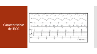Características
del ECG
TSV ortodrómica
 150-250 lpm, P retrógradas dentro del ST-T , RP < 1/2 RR, RP
<PR, RP constante, Qrs alternante.
 Depresión ST-T
 V3-V6: lateral izquierda
 DII,DIII,AVF: posteroseptal o posterior.
 V2-V3+ P positiva en inferiores: anteroseptal.
 Bloqueo funcional de rama
 BT ipsilateral (BRI).
TSVRAV antidrómica
 RR >250 lpm, QRS preexcitado.
 Amplitud ST-T ocultan la P retrógrada.
 RP > ½ R-R
 P-delta constante
 