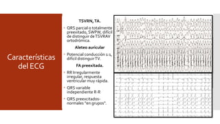 Características
del ECG
TRUP
 120-200 lpm, Incesante.
 Inicio-final espontáneo
cada pocos latidos.
 Sin previa CAP o CVP.
 QRS normal, RP largo> ½
R-R, P negativas
inferiores yV3-V6.
TSVRN,TA.
 QRS parcial o totalmente
preexitado, SWPW, difícil
de distinguir deTSVRAV
ortodrómica.
Aleteo auricular
 Potencial conducción 1:1,
difícil distinguirTV.
FA preexitada.
 RR Irregularmente
irregular, respuesta
ventricular muy rápida.
 QRS variable
independiente R-R
 QRS preexcitados-
normales “en grupos".
 