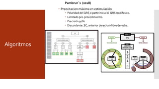 Algoritmos
Pambrun´s (2018)
 Preexitacion máxima en estimulación
 Polaridad del QRS o parte inicial si QRS isodifasico.
 Limitado pre-procedimiento.
 Precisión 90%
 Discordante: SC, anterior derecha y libre derecha.
 