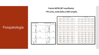 Fisiopatología
Patrón WPW (BT manifiesto)
 PR corto, onda delta y QRS amplio.
 