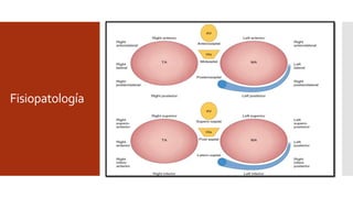 Fisiopatología
 Tradicional: Anterior/posterior-
Izquierda/derecha.
 Sin embargo: Posterior es inferior;
anterior es superior; AI es posterior,
AD es anterior.
 