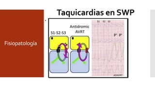 Fisiopatología
Taquicardias en SWP
• Macroreentrada dependiente
• Tamaño del circuito, heterogenicidad anatómica
• Heterogenicidad electrofisiológica: Dependiente de Na o CA
• Excentricidad del circuito
• Prematuridad
 