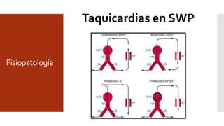 Fisiopatología
Taquicardias en SWP
 