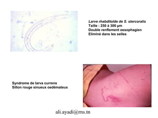 Larve rhabditoïde de S. stercoralis
                                       Taille : 250 à 300 µm
                                       Double renflement oesophagien
                                       Eliminé dans les selles




Syndrome de larva currens
Sillon rouge sinueux oedémateux




                        ali.ayadi@rns.tn
 