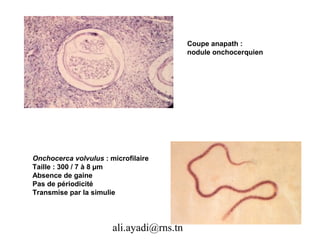 Coupe anapath :
                                          nodule onchocerquien




Onchocerca volvulus : microfilaire
Taille : 300 / 7 à 8 µm
Absence de gaine
Pas de périodicité
Transmise par la simulie




                       ali.ayadi@rns.tn
 