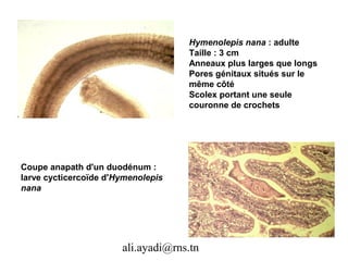 Hymenolepis nana : adulte
                                    Taille : 3 cm
                                    Anneaux plus larges que longs
                                    Pores génitaux situés sur le
                                    même côté
                                    Scolex portant une seule
                                    couronne de crochets




Coupe anapath d'un duodénum :
larve cycticercoïde d'Hymenolepis
nana




                       ali.ayadi@rns.tn
 