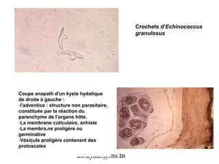 Crochets d'Echinococcus
                                             granulosus




Coupe anapath d'un kyste hydatique
de droite à gauche :
-l'adventice : structure non parasitaire,
constituée par la réaction du
parenchyme de l'organe hôte.
-La membrane cuticulaire, anhiste
-La membra,ne proligère ou
germinative
-Vésicule proligère contenant des
protoscolex

                          ali.ayadi@rns.tn
 