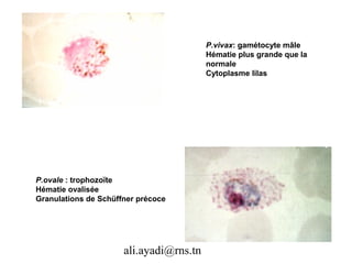 P.vivax: gamétocyte mâle
                                         Hématie plus grande que la
                                         normale
                                         Cytoplasme lilas




P.ovale : trophozoïte
Hématie ovalisée
Granulations de Schüffner précoce




                      ali.ayadi@rns.tn
 