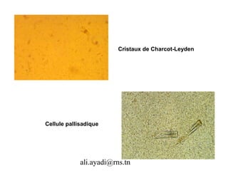 Cristaux de Charcot-Leyden




Cellule pallisadique




             ali.ayadi@rns.tn
 