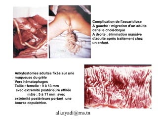 Complication de l'ascaridiose
                                           A gauche : migration d'un adulte
                                           dans le cholédoque
                                           A droite : élimination massive
                                           d'adulte après traitement chez
                                           un enfant.




Ankylostomes adultes fixés sur une
muqueuse du grêle
Vers hématophages
Taille : femelle : 9 à 13 mm
 avec extrémité postérieure effilée
          mâle : 5 à 11 mm avec
extrémité postérieure portant une
bourse copulatrice.

                        ali.ayadi@rns.tn
 