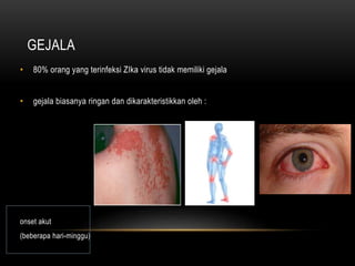 GEJALA
• 80% orang yang terinfeksi ZIka virus tidak memiliki gejala
• gejala biasanya ringan dan dikarakteristikkan oleh :
onset akut
(beberapa hari-minggu)
 