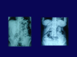 Amilaz ile yaralanma ciddiyeti arasında korelasyon YOK