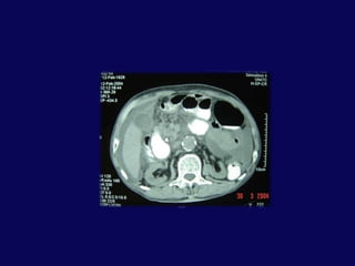 BT- pankreas çevresi, retroperitoneal serbest hava, kontrast ekstravazasyonuTanıDÜZ GRAFİAlt torasik- Üst lombervertebra kırığı