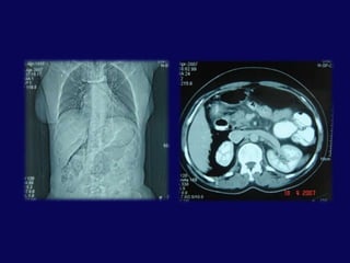 Sağ psoas kası boyunca veya sağ böbrek hizasında hava
