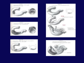 Lasser Sac’da sıvı