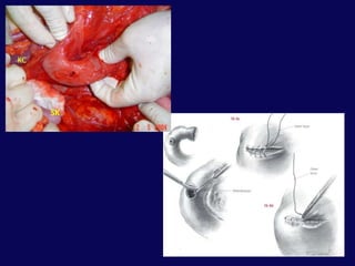 Anteriorrenalfasyanın kalınlaşması veya kopması 