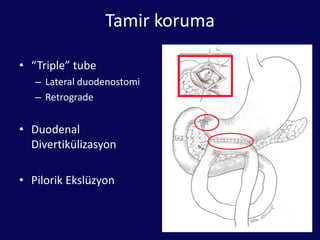 Duodenum yaralanması  evrelemeEvre    Yaralanma tipi   YaralanmaI	HematomDuodenumbir bölümünde lokalizeLaserasyonDuodenum duvarının kısmi yaralanmasıII	Hematom	Birden fazla duodenum bir bölümü kapsayanLaserasyonDuodenum çapının %50 den azındaIII	LaserasyonDuodenum II. bölümde çapın %50-75                                                 D1, D3, D4 bölümde çapın %50-100 i IV             Laserasyon            D2 lümen çapının >%75’i Ampullave distal safra yollarını içerenV	LaserasyonDuodenopankreatikkompleksin bozulmasıDuodenumundevaskülarizasyonu(AAST Organ InjuryScore)