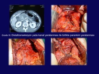– Nekroz, kanama, abse, fistül, psödokist– Endokrin %20• Ana pankreas kanal rüptürükünt travmalarda %1.6 görülür