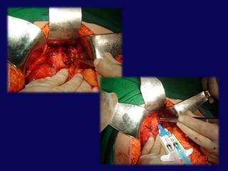 Grade III: Distaltranseksiyon yada kanal yaralanması ile birlikte parankim yaralanması