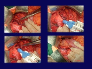 Ana pankreatik kanalın değerlendirilmesiIntraoperatifpankreatografiTransduodenalkanulasyonDistalkanulasyonKolesisto-kolanjiografiIntraoperatif ERCP