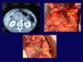 Pankreatik kanal yaralanmasına göre tedavi planı 