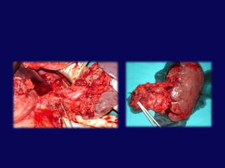 Major ductus yaralanması = cerrahi