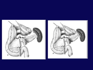 ? Duodenal yaralanmaLaparotomiOrta hat kesisiKanama ve kontaminasyon kontrolüPankreas kanal bütünlüğünün değerlendirilmesiTransvers  kolonun ve hepatikfleksuranın serbestleştirilmesiGenişletilmiş Kocher manevrasıOmentumun kolondan ayrılmasıPankreasın görünür hale getirilmesiOmentumminusun açılması, Duodenum 2. kısmın tam kocherizasyonu