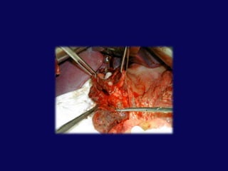 KANALIN KESİLDİĞİ DİSTAL YARALANMALARDistal pankreatektomiSplenektomiRoux-en-Y anastomozuMultitravmalı hastalarda zaman açısından uygun değildir.